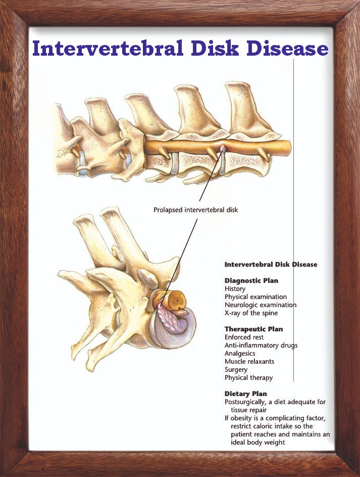 Intervertebral Disk Disease Chart 12x18 inches