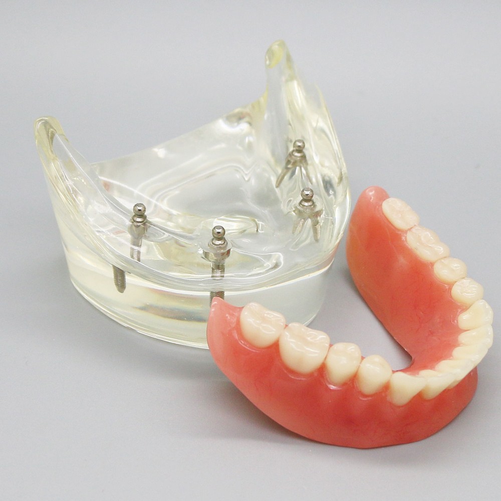 Dental Oral Transparent Upper Teeth 2/4 Implants Model Overdenture Restoration