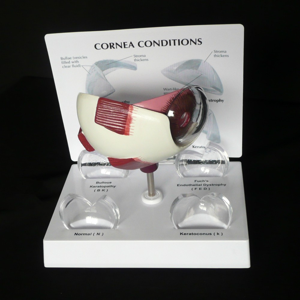 Anatomical Human Corneal Disease Model