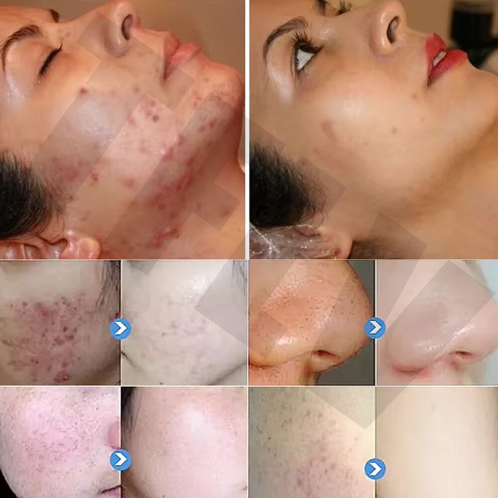 hydrogen oxygen small bubbles jet peel water oxygen hydro deep cleansing Device