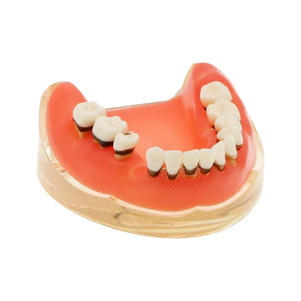 Dental Periodontal Pathological Disease M4017 Removable Teaching Study Model