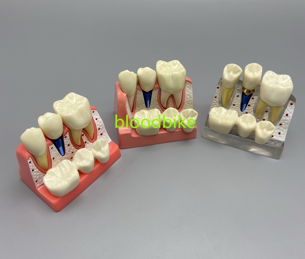 1pc Dental Typodont Teeth Study Teach Model Implant Endo Caries Demonstration