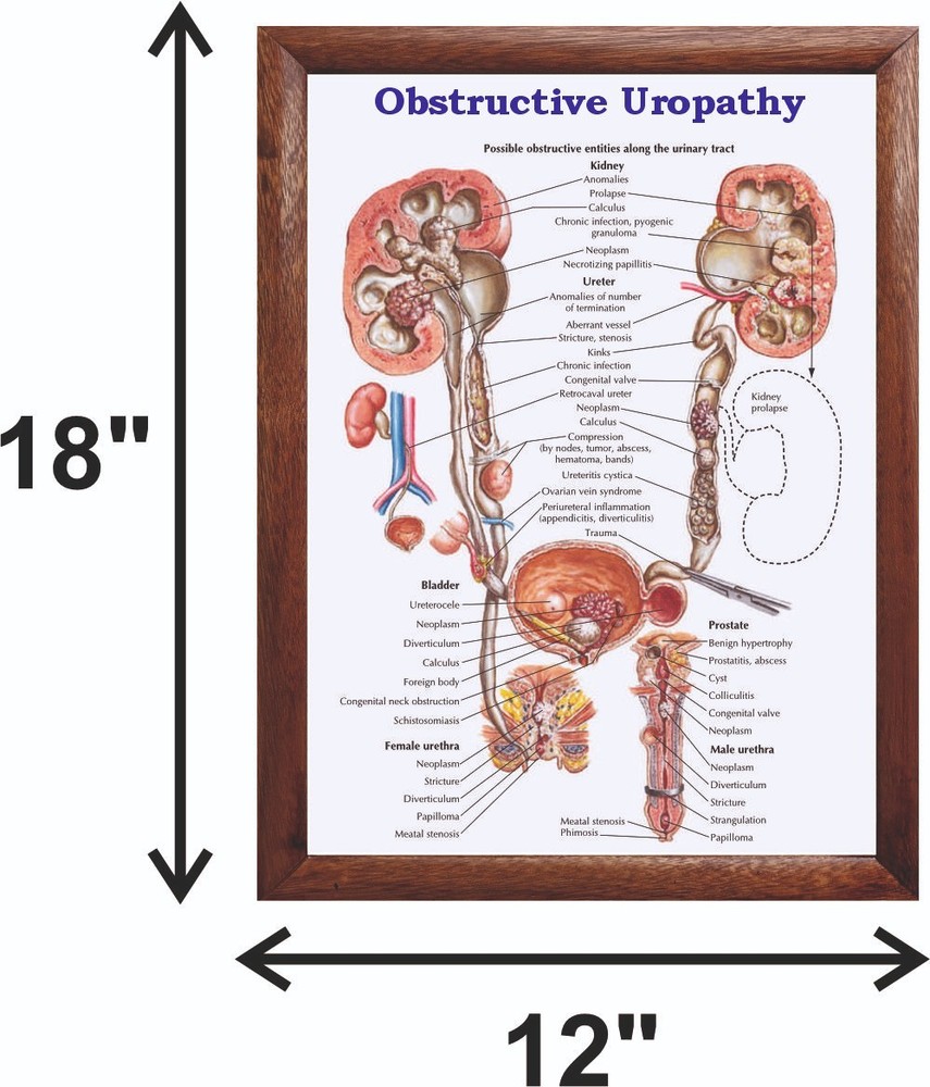 Obstructive Uropathy Chart 12x18 inches