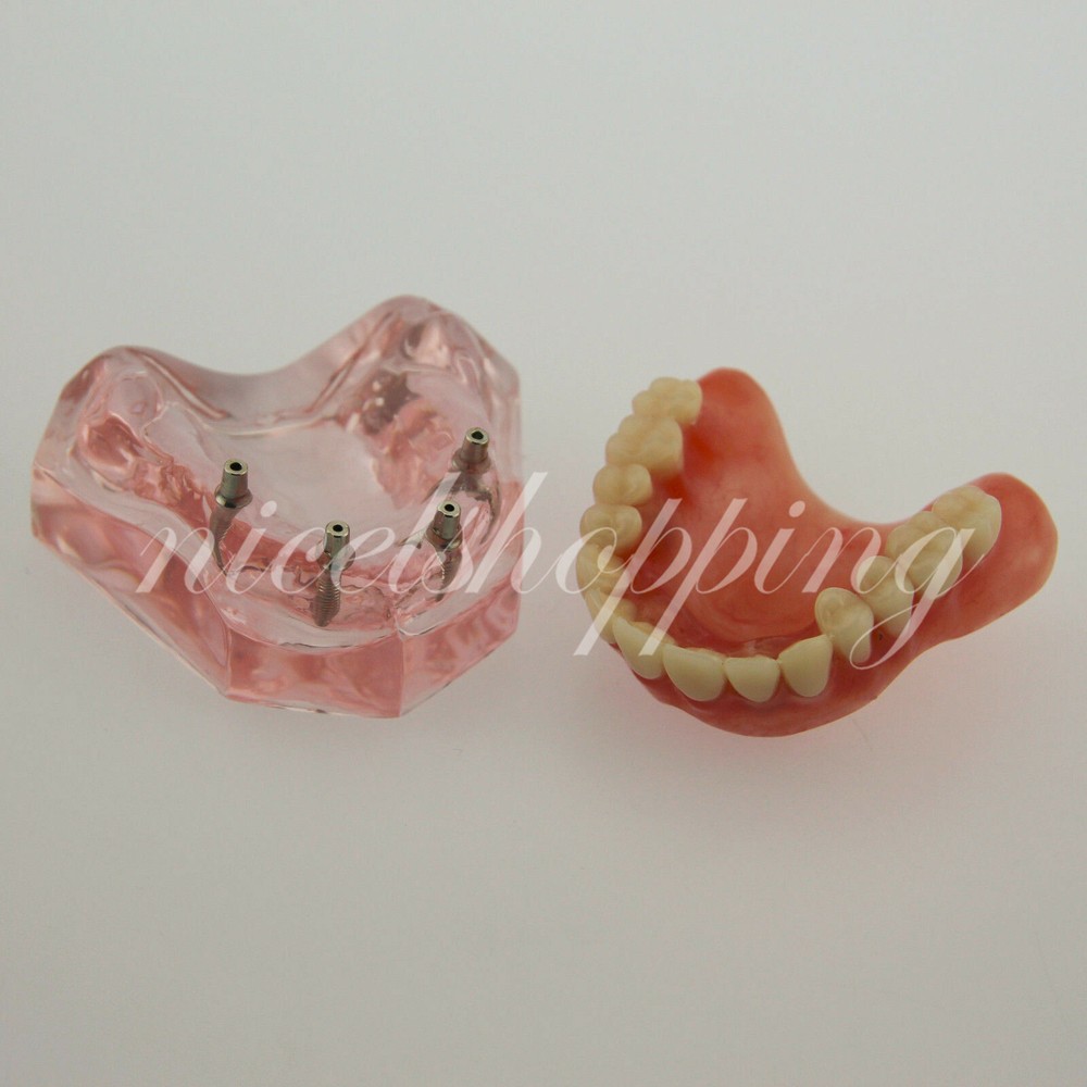 Dental Overdenture Teeth StudyInferior 4 Implant Demo Model Teaching Study
