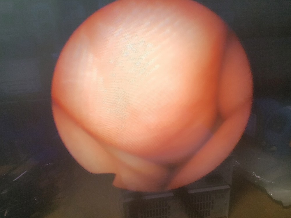 Olympus Arthroscope A7506A w Sheath & Light Cable