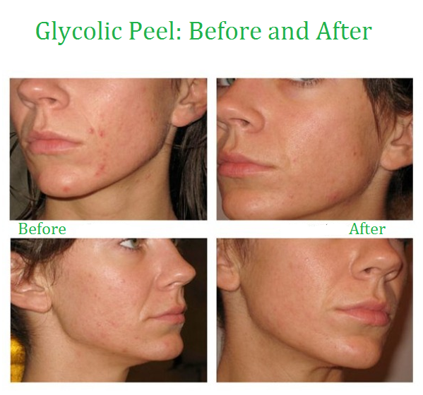 Glycolic Acid Face Peel Kit Medical Grade Pure Acne Scars Wrinkles Anti-Aging