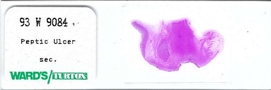 Human Peptic Ulcer Pathology Microscope Slide