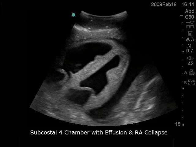 Cardiac Echo Ultrasound Training Model