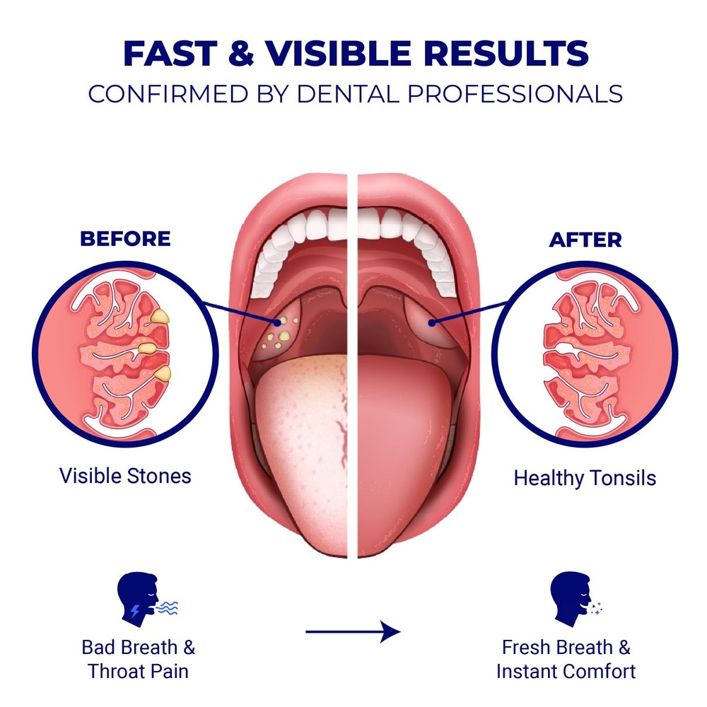 Tonsil Stone Remover - Tonsil Stone Removal Kit - Tonsillolith Remover Tool -...