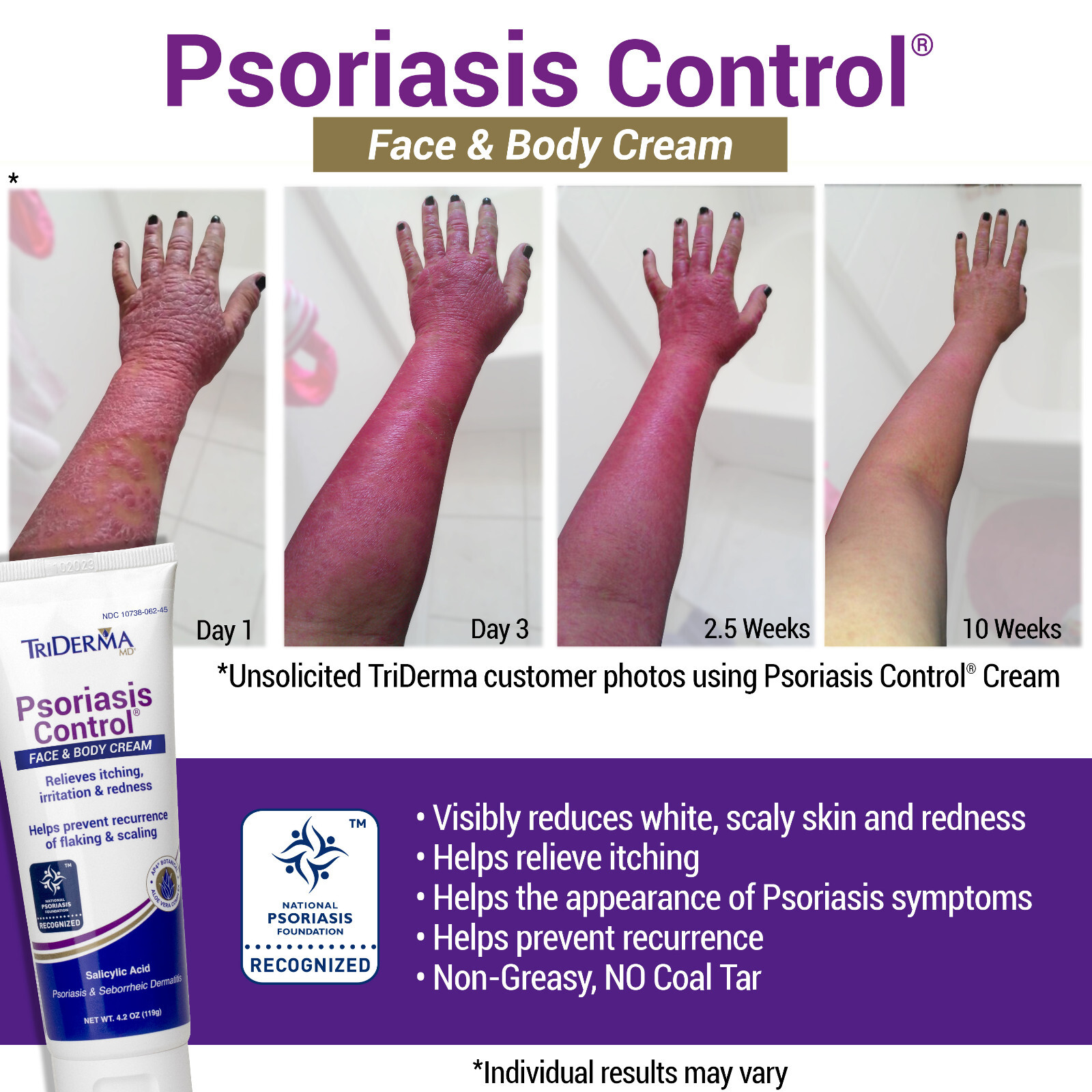 TriDerma Psoriasis Control Face & Body Cream - FSA Eligible, 4.2 oz - 4-Pack