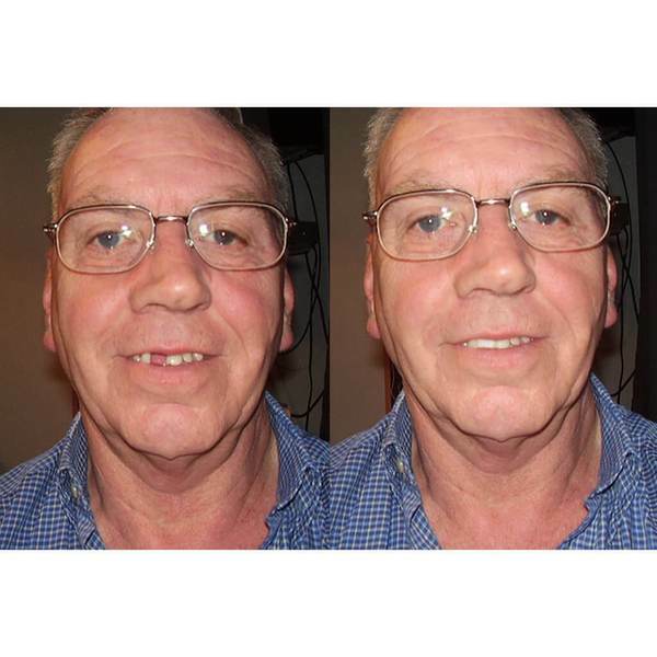 Temptooth Kit Original Temp tooth Missing Tooth Replacement Over 250,000 Sold