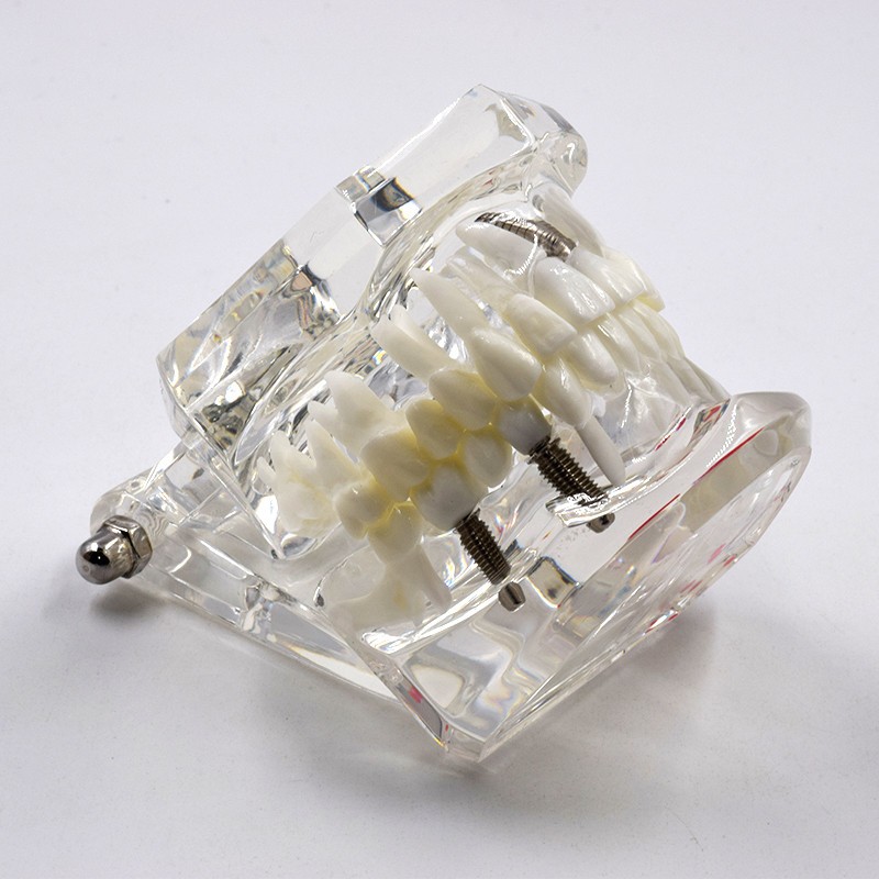 Dental Removable Restoration &Implant Pathological Disease Teeth Study Model