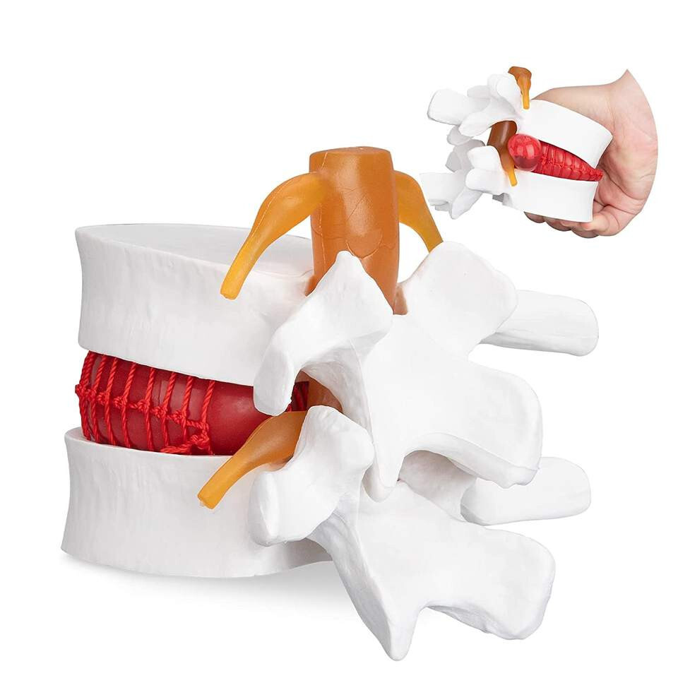 1:1.5 Human Spine and Vertebra Pathological Model Lumbar Disc Herniation Model