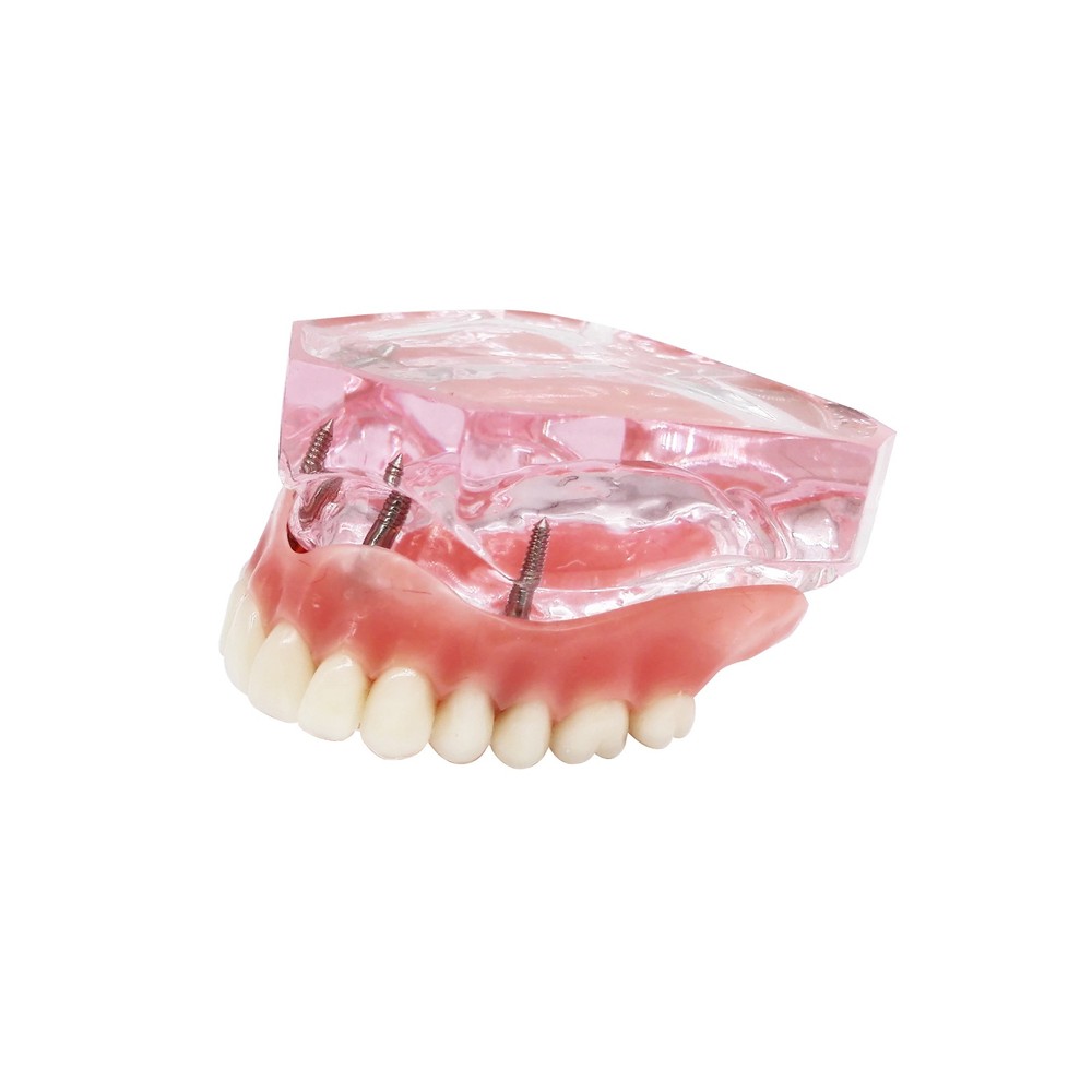 Dental Implant Teeth Model Demo Overdenture Restoration With 4 Implants Upper