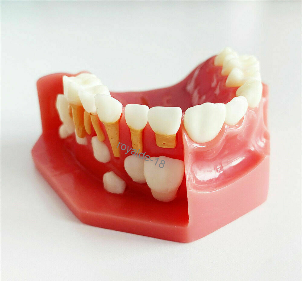 Dental Teaching Pediatrics Teeth Children 5-9Years Old Permanent Alternate Model