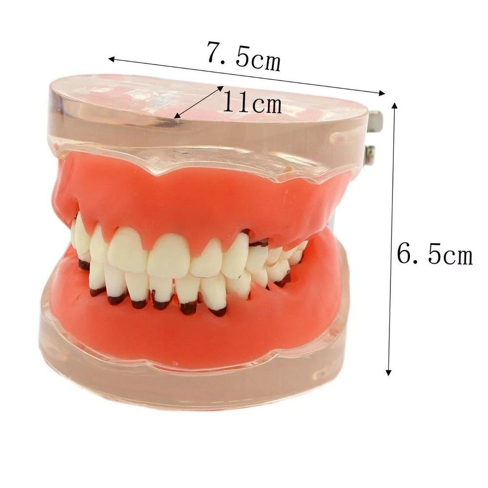 Dental Teeth Model Pathological Disease M4017 Removable Teaching Study Model