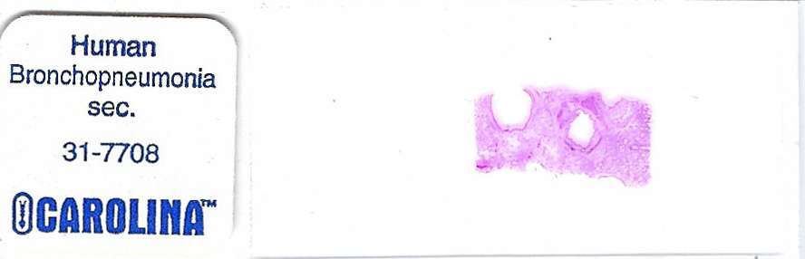 Human Bronchopneumonia Pathology Microscope Slide