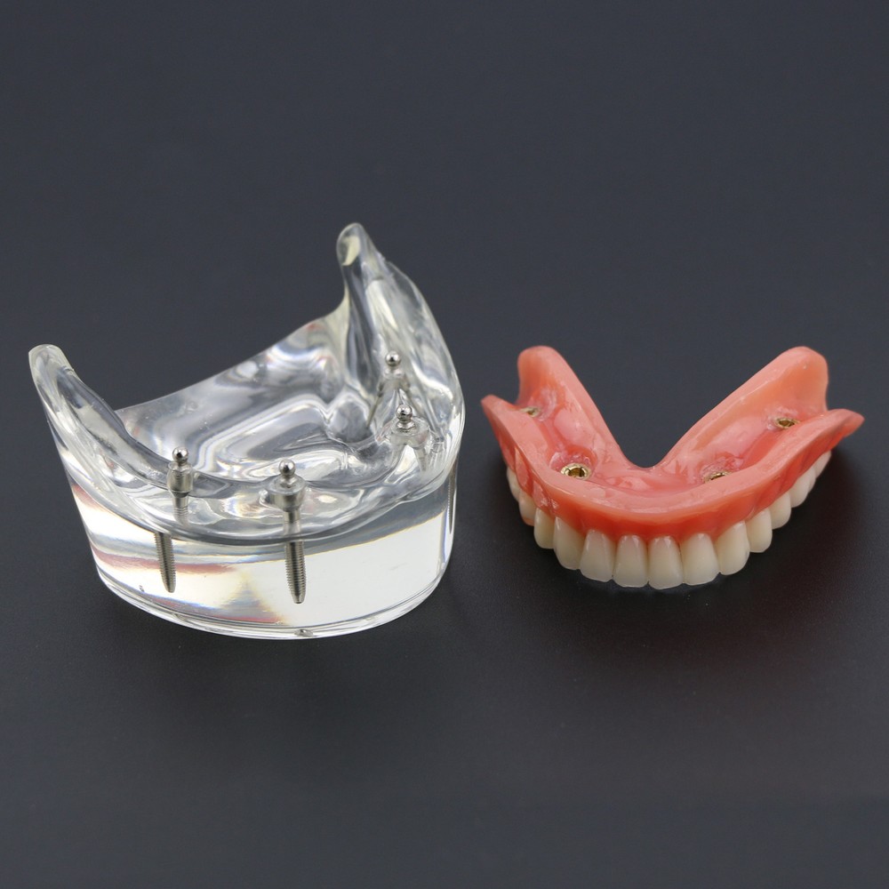 Dental Typodont Lower Teeth Demo Study Model Overdenture Inferior 4 Implants