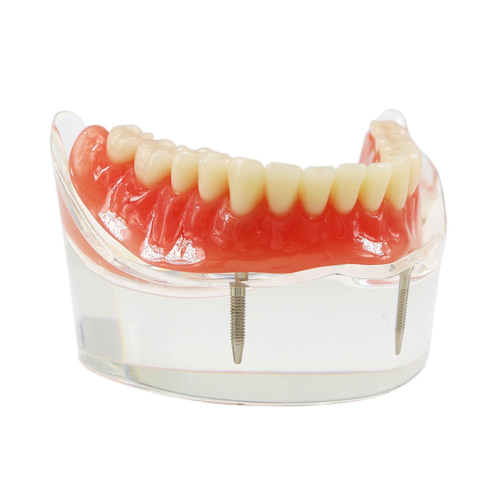Dental Implant Typodont Teeth Restoration Model Series Overdenture Practice Demo