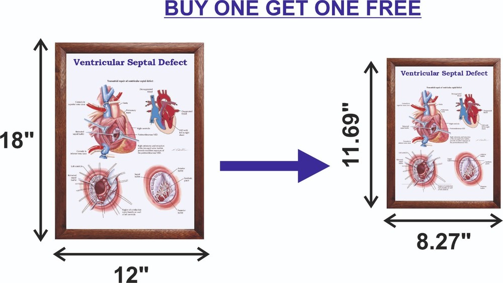 Ventricular Septal Defect Chart 12x18 inches
