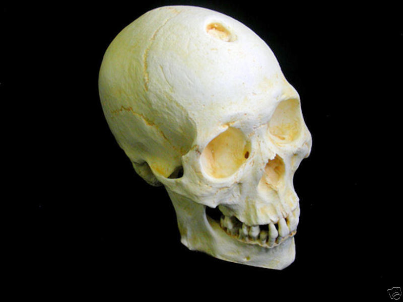 MONGOLOID HUMAN WITH TREPANATION SKULL  REPLICA
