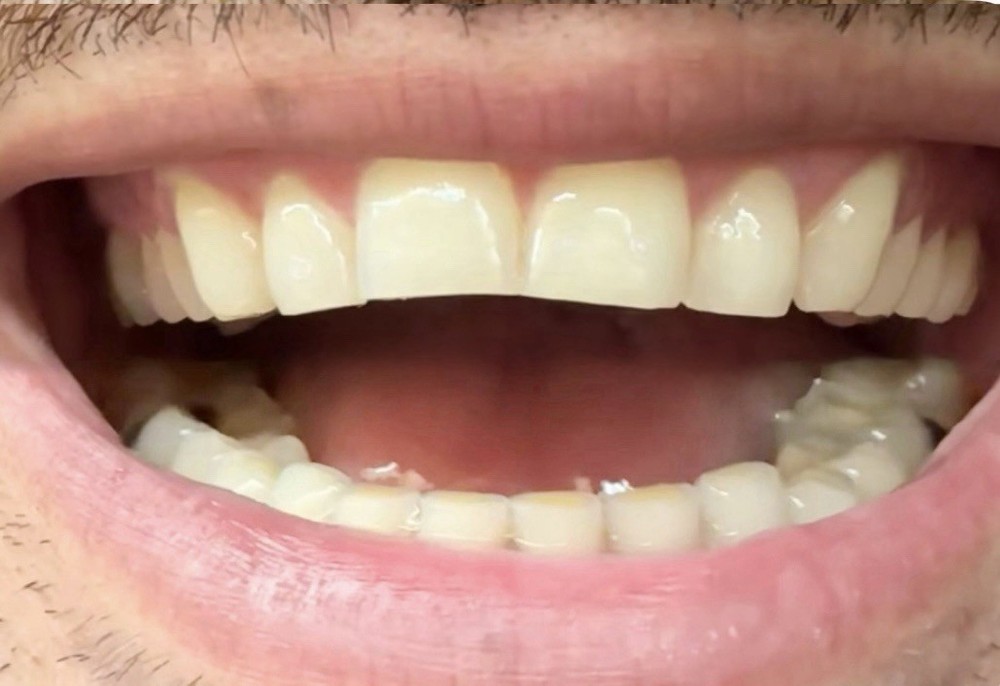 Custom Upper or Lower Cosmetic Click on Veneer