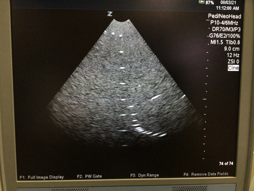 Zonare P10-4 Phased Array Ultrasound Probe 84006