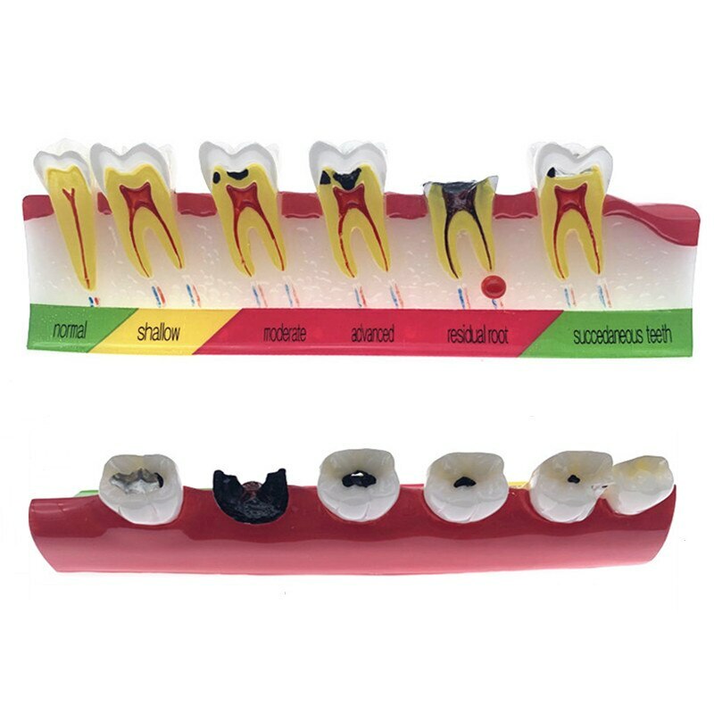 Dental Caries Classify/Evolution model Tooth Model Dental Study Model