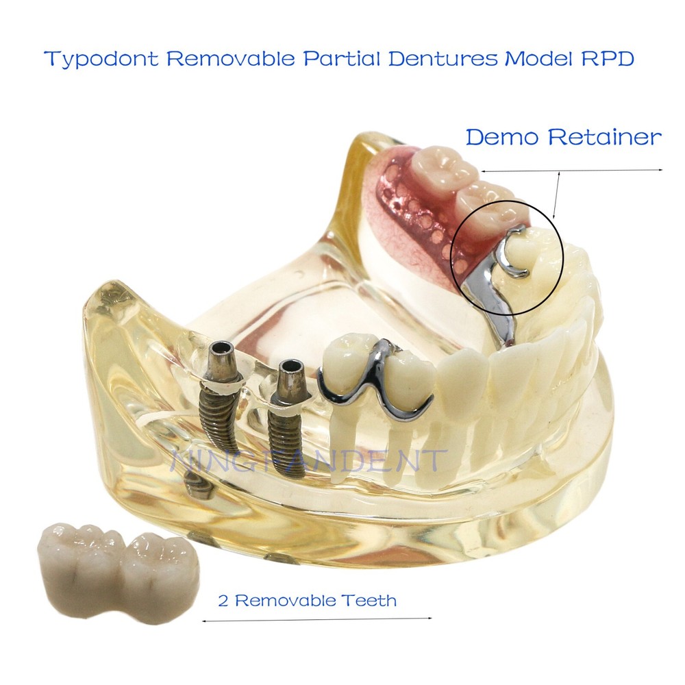 Dental Implant RPD Restoration Model Removable Partial Denture Lower 2 Implants