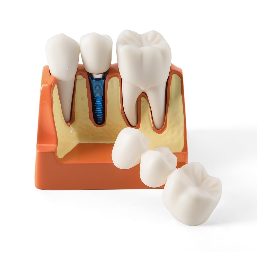 4 Times Dental Analysis Crown Bridge Demonstration Removable Teaching Model