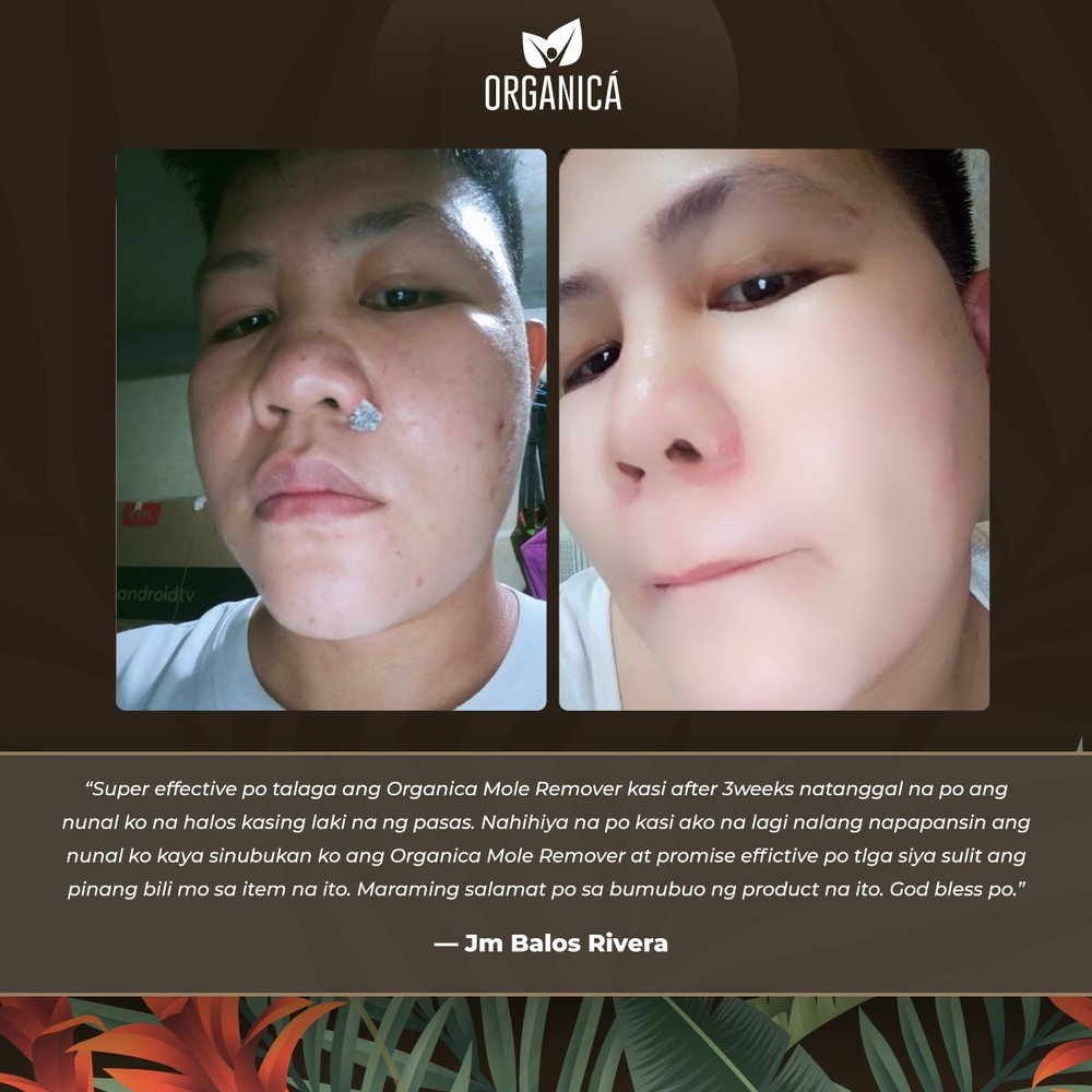 Multi-Awarded Mole and Warts Remover Set