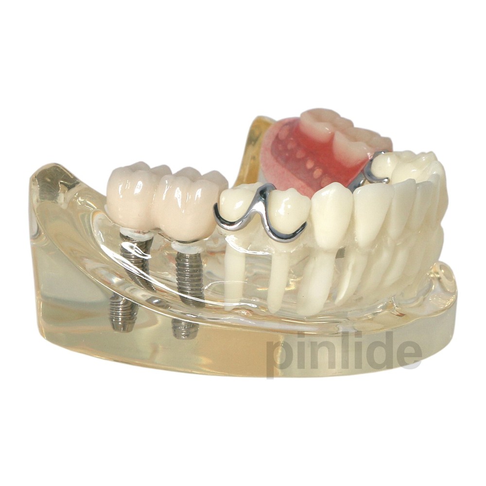 Dental Typodont Restoration Model With 2 Implants Partial Denture Demo M6022