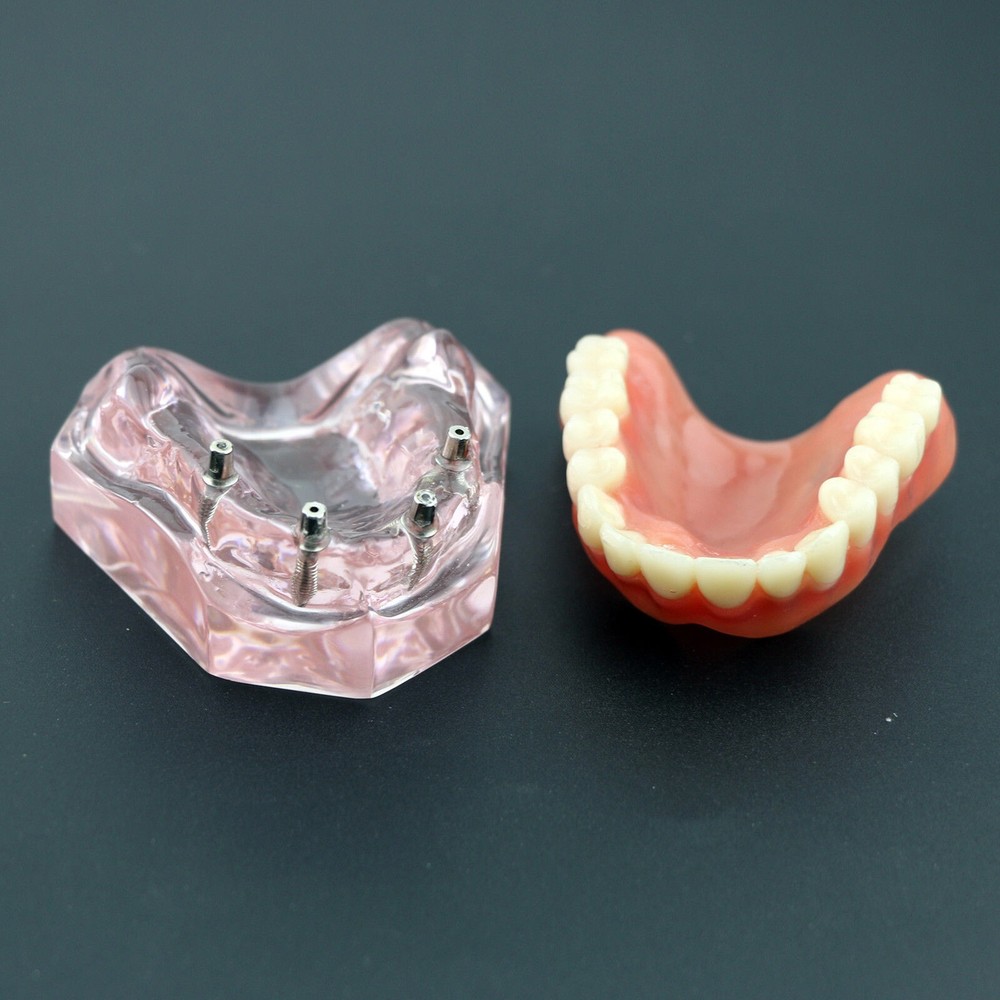 Dental Implant Overdenture Upper Superior Model Precision 4 Maxillary
