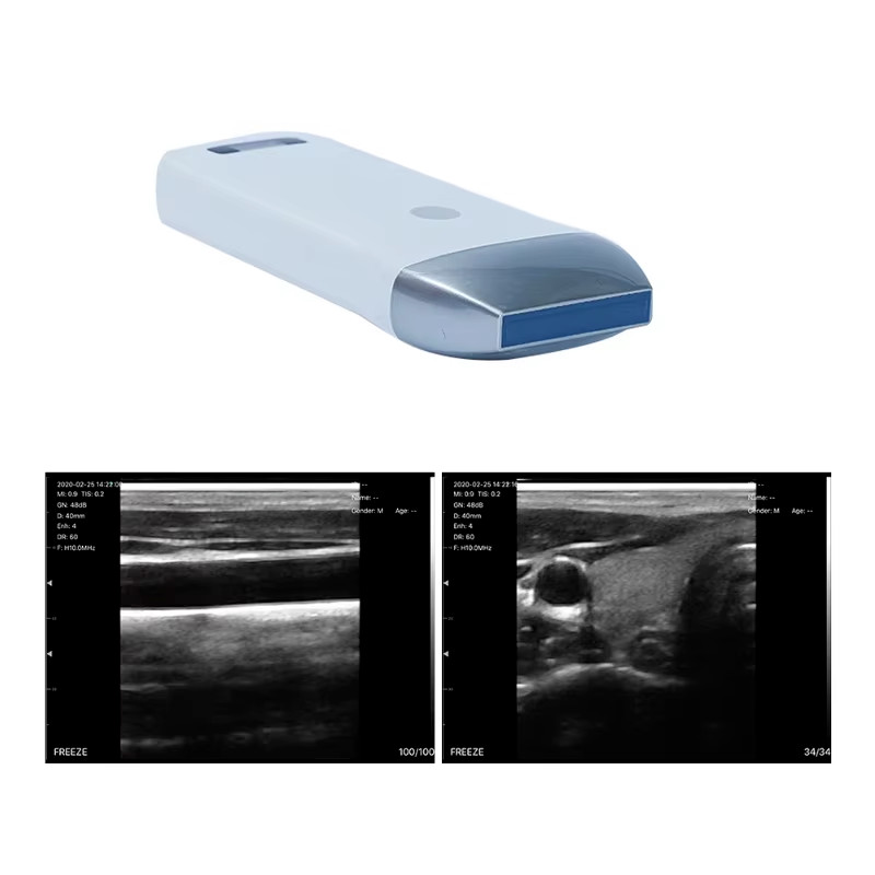 Wireless Linear Ultrasound Probe - 80-Element, Multi-Platform for iOS/Android/PC