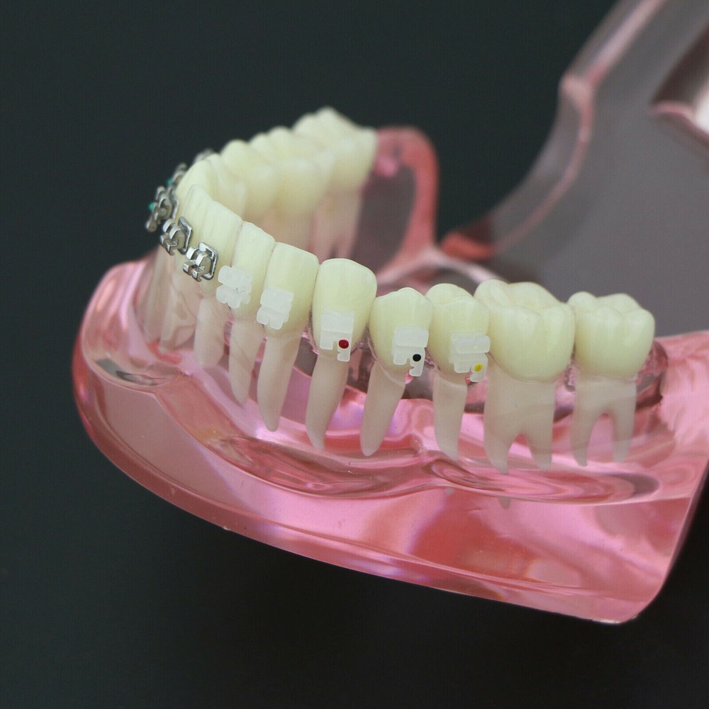 Dental Orthodontic Demonstration Ceramic and Metal Bracket Study Typodont Model