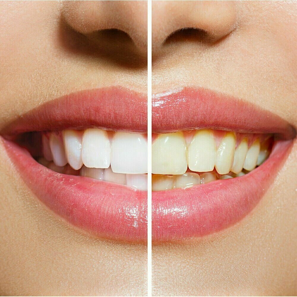 Professional LED Accelerator Light for Faster Teeth Whitening Includes Batteries