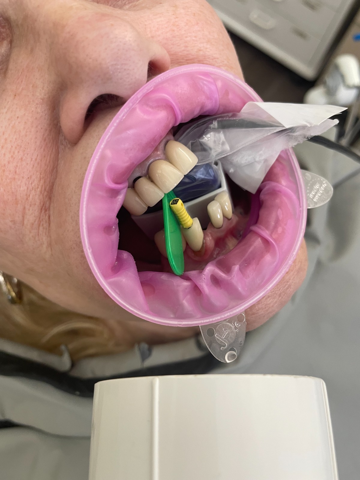 60 pcs Autoclavable - Apical/Bitewing Adult Digital Sensor Positioner-Holder