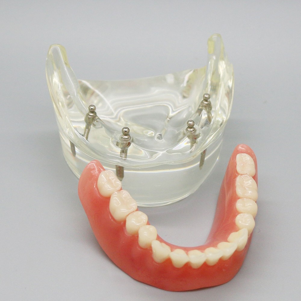 1 PC Dental Overdenture Inferior Teeth Model 4 Implants Restoration Lower M6003