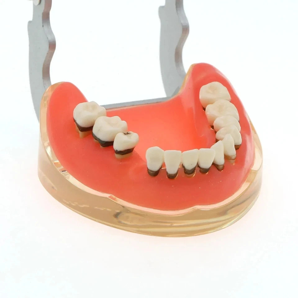 Dental Periodontal Pathological Disease M4017 Removable Teaching Study Model