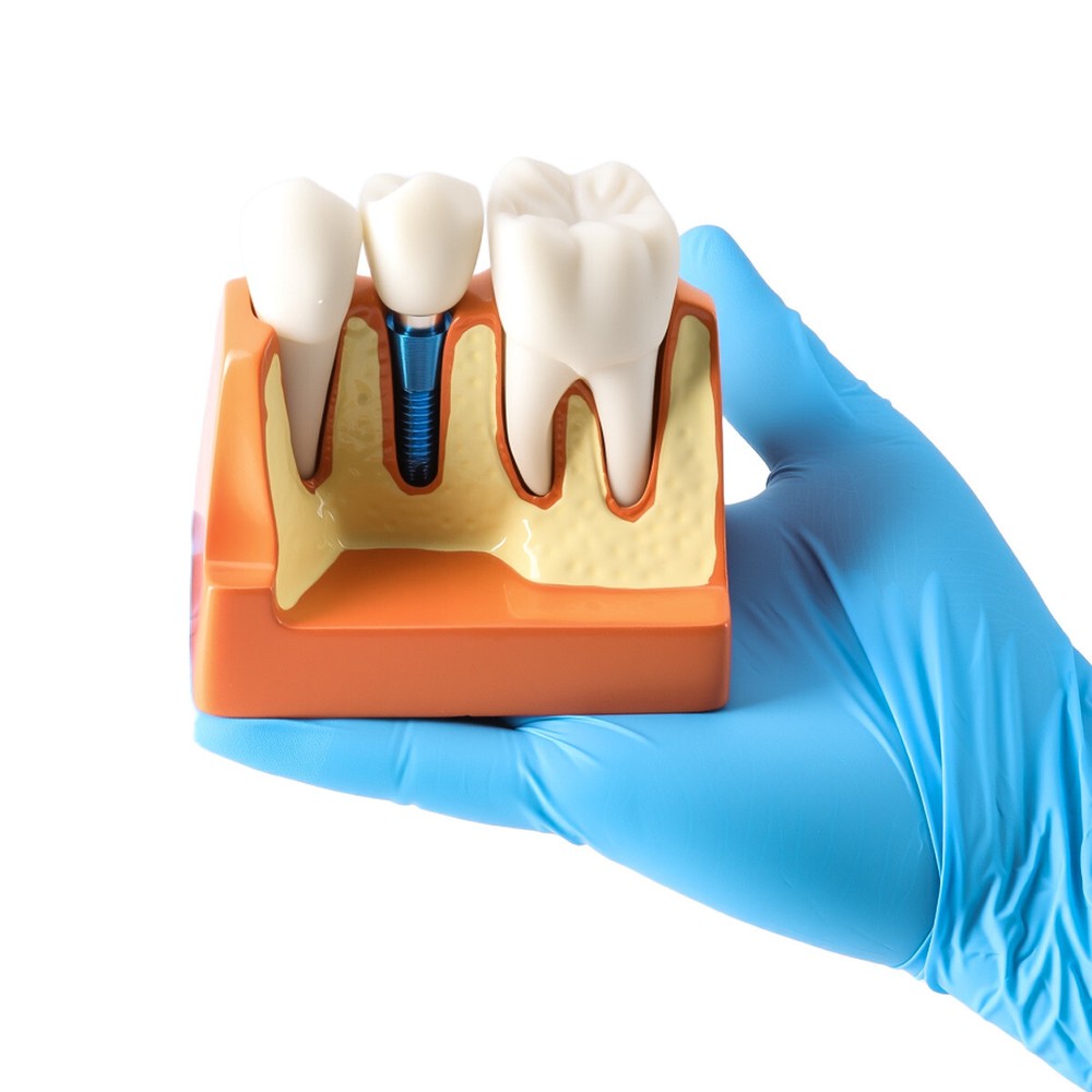 Dental 4Times Teeth Model Implant Analysis Crown Bridge Removable Study Training