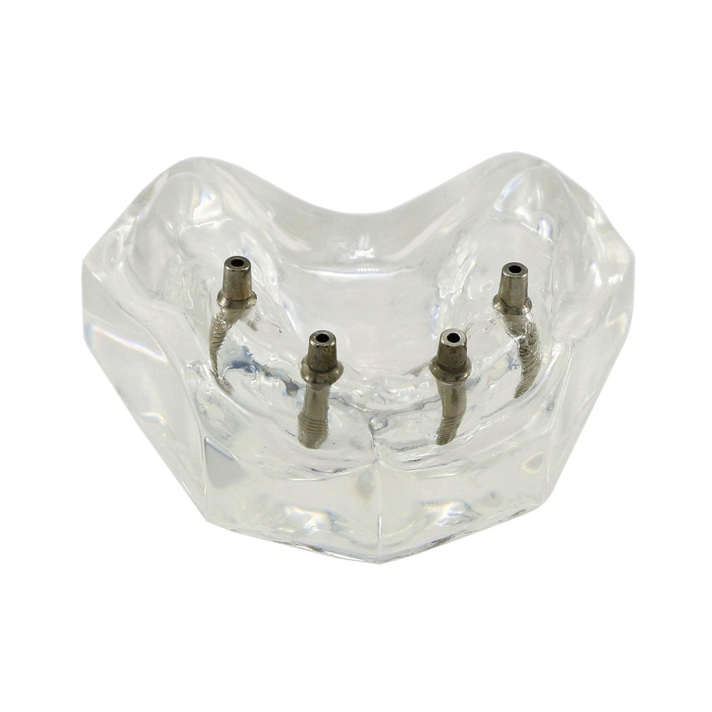 Dental Upper Implants Model Overdenture with 4 Superior Teeth Demo Transparen...