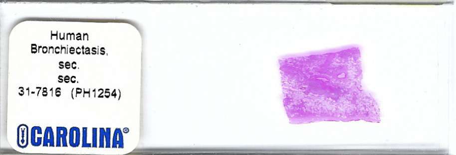 Human Bronchiectasis Pathology Microscope Slide