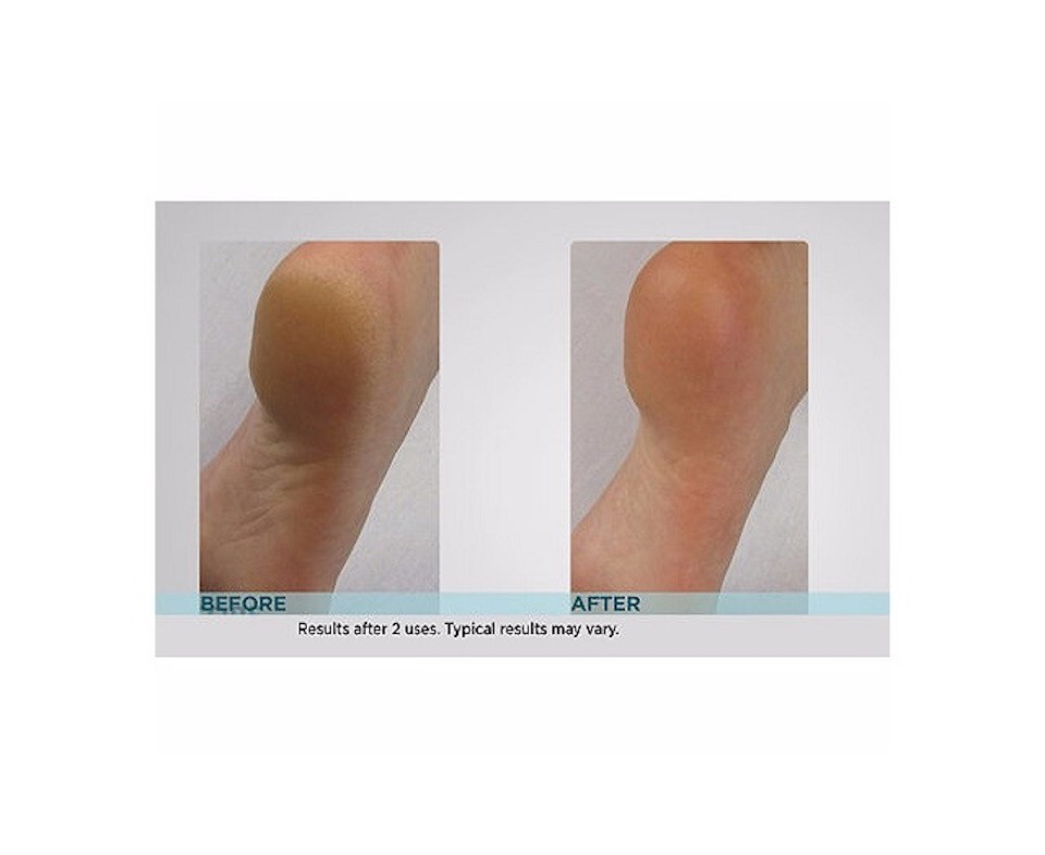 Emjoi Micro Pedi Callus Remover Foot File with Extra Coarse Roller (White)