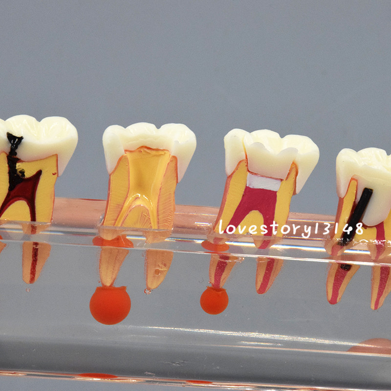 1 Set Dental Teeth Model #4018 01 - 4-Stage Endodontic Treatment Study Model