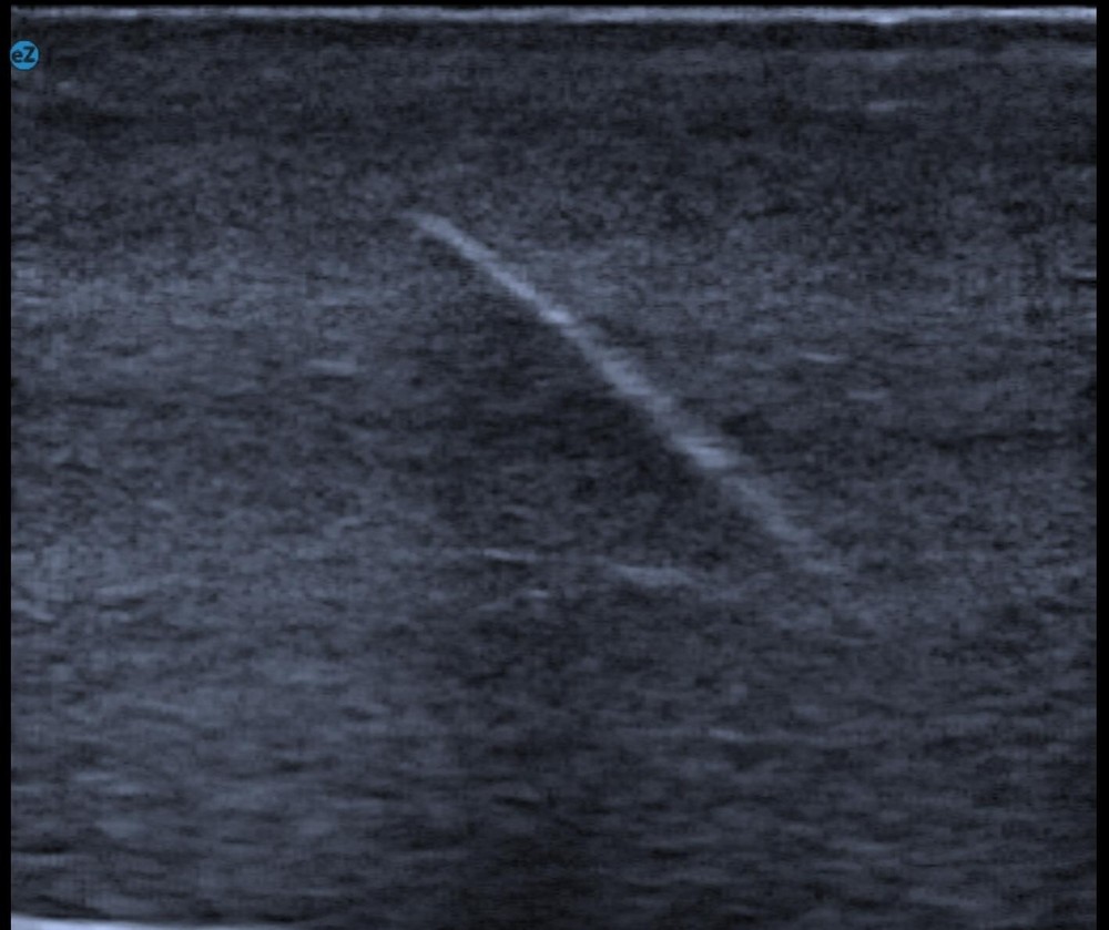 ultrasound foreign body phantom trainer