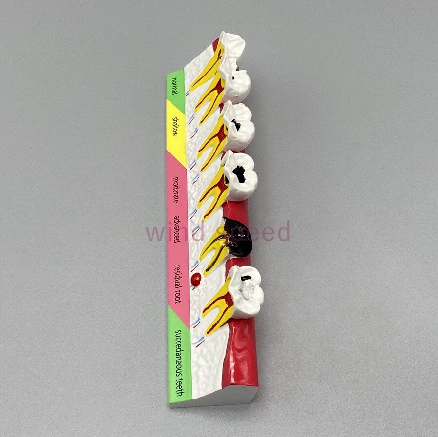 Dental lab Study Teaching Models Caries Disease Assort Teeth Dentoform Model