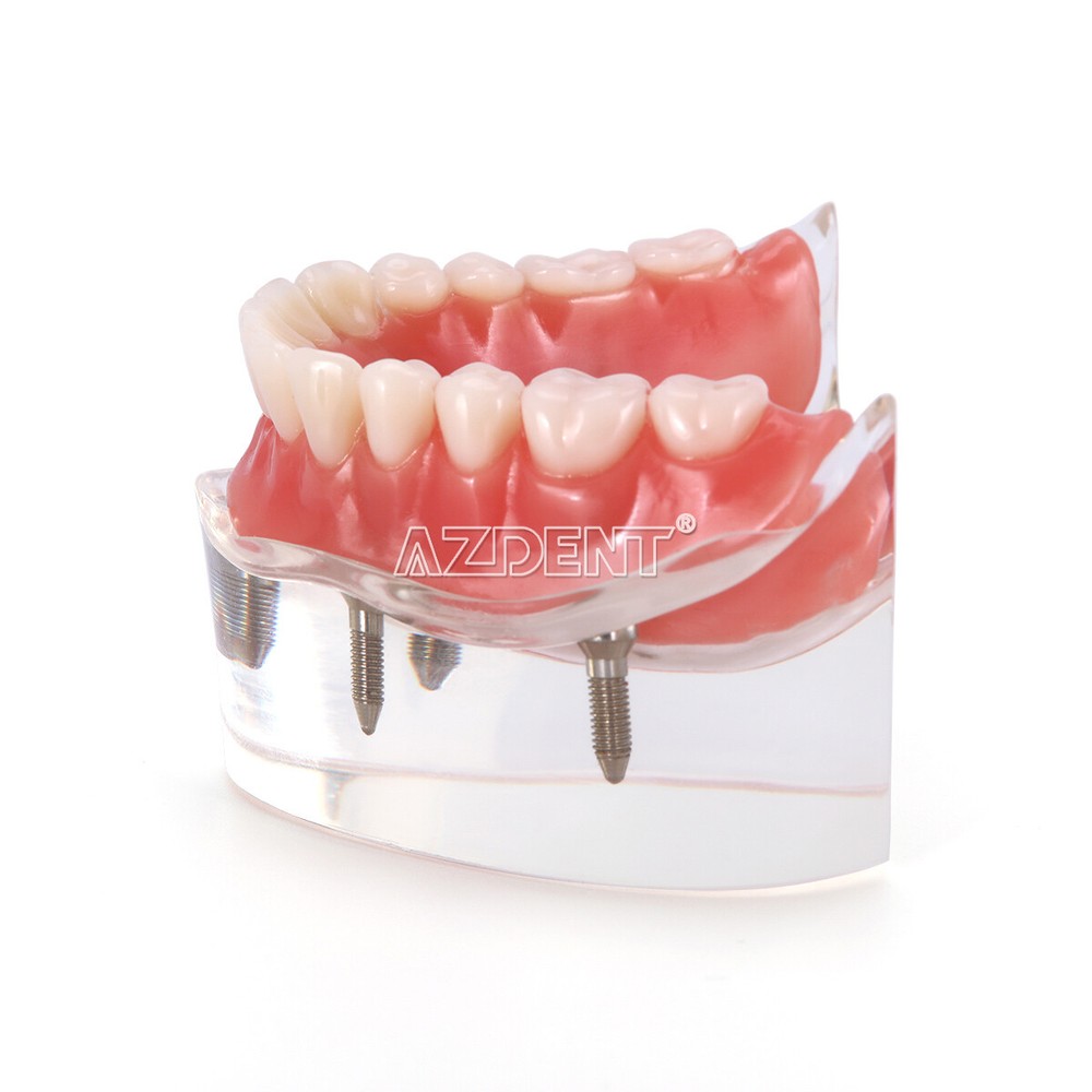 Dental Implant Teach Study Model Demo Overdenture Typodont 4Implants Upper Lower