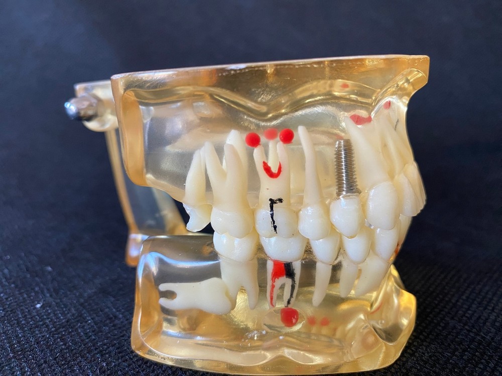 Dental Teeth Study Teaching Model Cavity Various Diseases Implant Impact Teeth