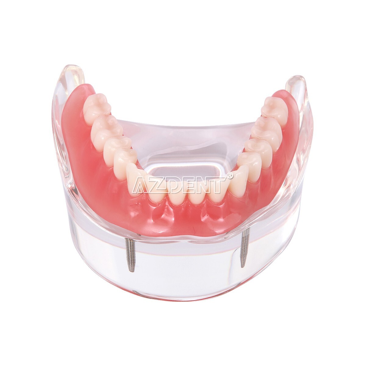 Dental Implant Teeth Model Demo Overdenture Restoration With Implants Lower
