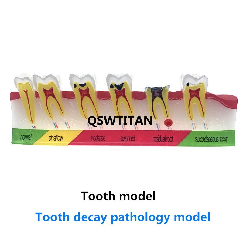 Dental Caries Classify/Evolution model Tooth Model Dental Study Model
